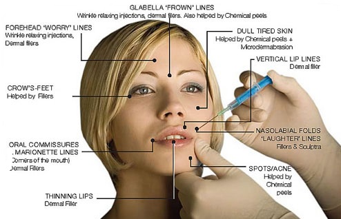 botox-injections-face